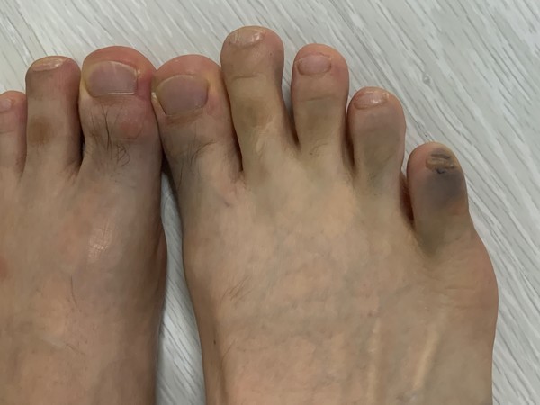 ▲충분히 주의해 착용했음에도 불구하고 샌들에 의해 발가락이 까맣게 물들었다.