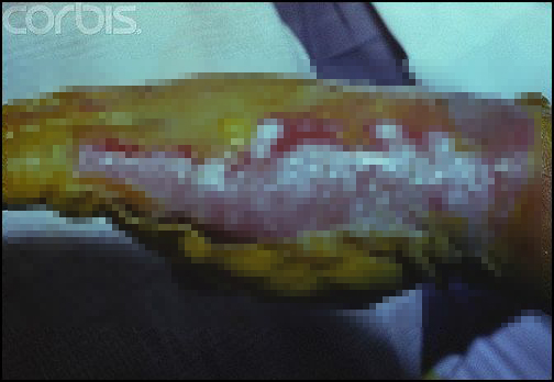 체르노빌 원전 사고 피해자의 손