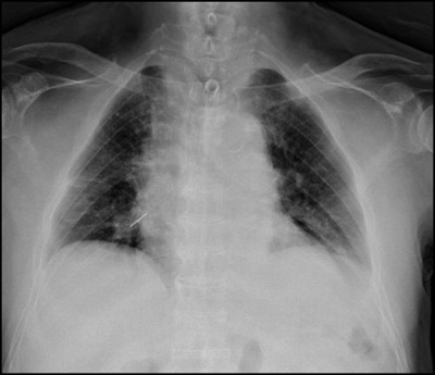 노태우 전 대통령 엑스레이 사진