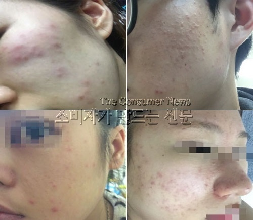 화장품 트러블.jpg