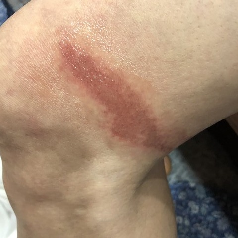 마트에서 구입한 그린제약 파스를 뿌려 화상을 입었다며 소비자가 분통을 터트렸다