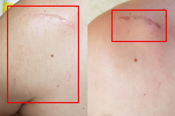 ▲선 씨는 GC녹십자의 '제놀 파워풀 플라스타'를 어깨에 부착 후 살점이 떨어져 나가는 부작용을 겪었다