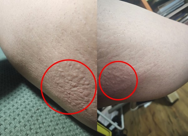 ▲ 제모 스프레이를 뿌린 피부에 수포처럼 피부가 올라왔다
