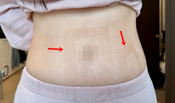 ▲복부에 아쿠아드레싱 형태 그대로 자국이 남아있다